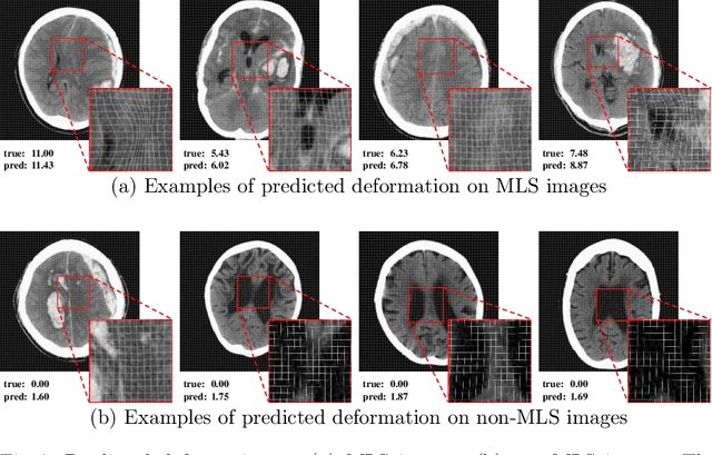 Figure 4 for Diffusion Model based Semi-supervised Learning on Brain Hemorrhage Images for Efficient Midline Shift Quantification