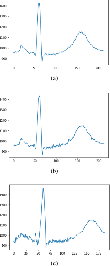 Figure 2 for Parameterization of state duration in Hidden semi-Markov Models: an application in electrocardiography