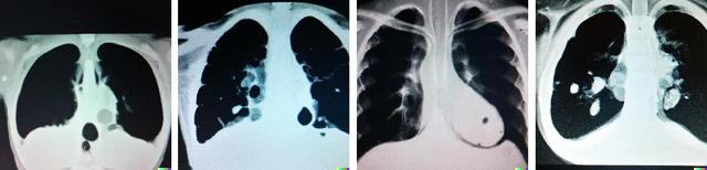 Figure 3 for Spot the fake lungs: Generating Synthetic Medical Images using Neural Diffusion Models