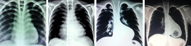 Figure 4 for Spot the fake lungs: Generating Synthetic Medical Images using Neural Diffusion Models