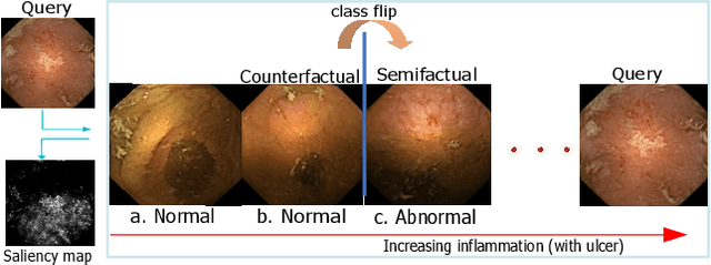 Figure 2 for This changes to that : Combining causal and non-causal explanations to generate disease progression in capsule endoscopy