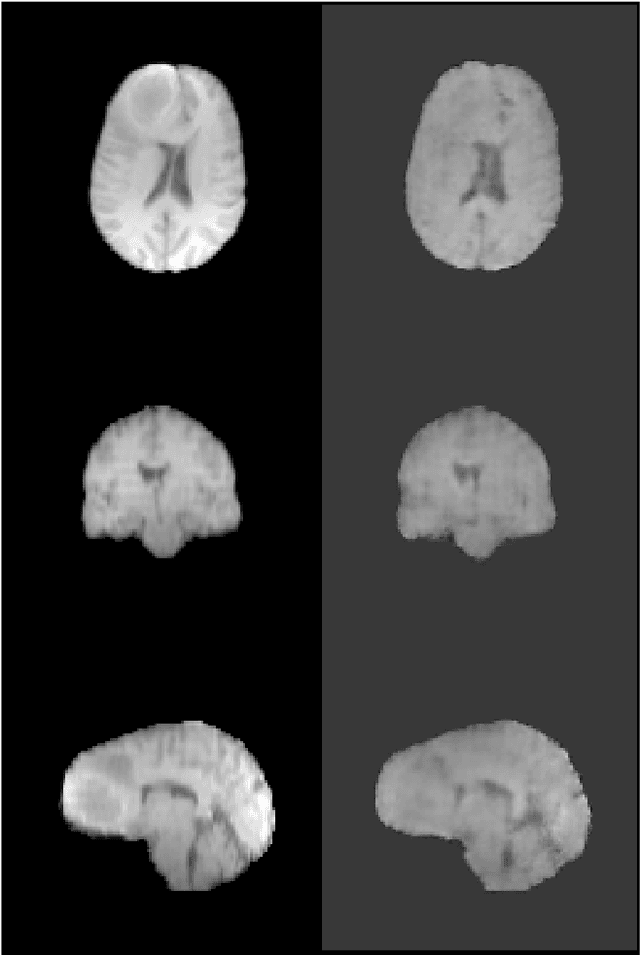 Figure 2 for Denoising Diffusion Models for 3D Healthy Brain Tissue Inpainting