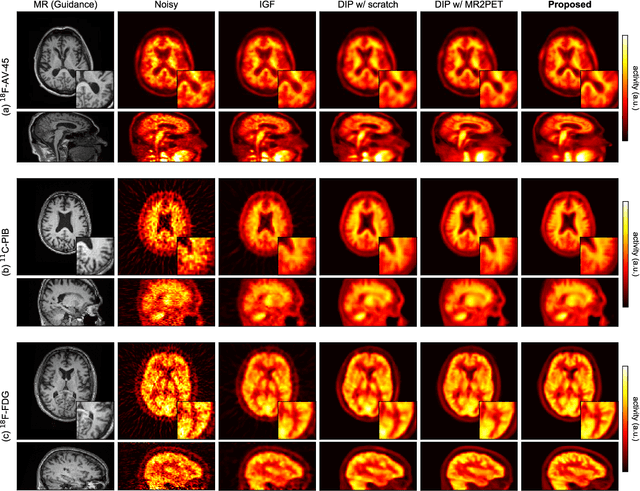 Figure 2 for Self-Supervised Pre-Training for Deep Image Prior-Based Robust PET Image Denoising