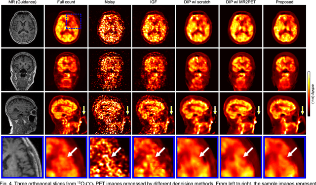 Figure 4 for Self-Supervised Pre-Training for Deep Image Prior-Based Robust PET Image Denoising