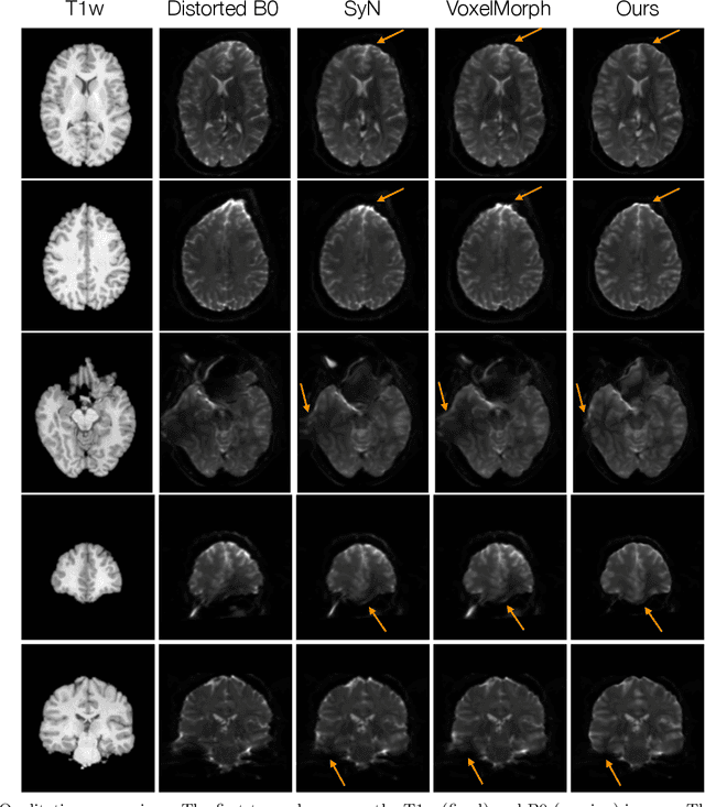Figure 3 for DrDisco: Deep Registration for Distortion Correction of Diffusion MRI with single phase-encoding