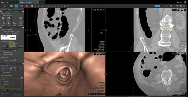 Figure 1 for Immersive Virtual Colonoscopy Viewer for Colorectal Diagnosis