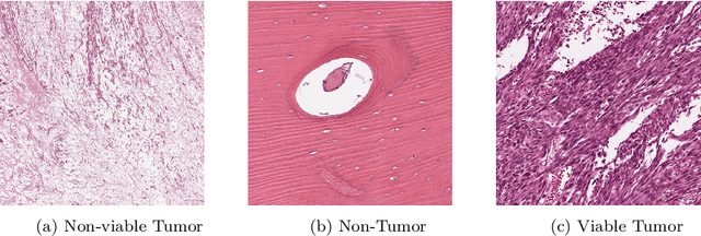 Figure 3 for Osteosarcoma Tumor Detection using Transfer Learning Models