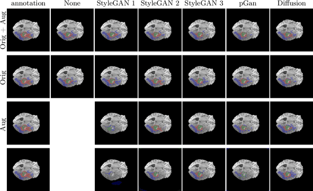 Figure 4 for Brain tumor segmentation using synthetic MR images -- A comparison of GANs and diffusion models