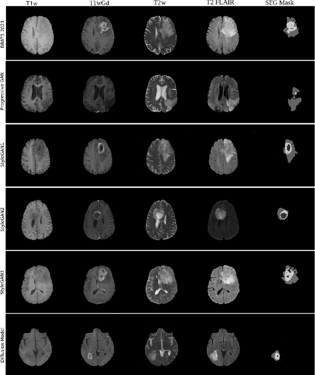 Figure 2 for Brain tumor segmentation using synthetic MR images -- A comparison of GANs and diffusion models