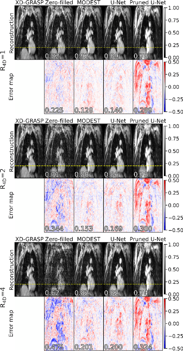 Figure 3 for Accelerated respiratory-resolved 4D-MRI with separable spatio-temporal neural networks