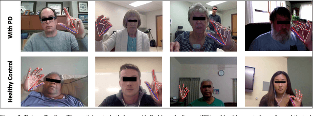 Figure 3 for Using AI to Measure Parkinson's Disease Severity at Home