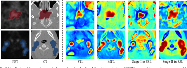 Figure 3 for DeepMSS: Deep Multi-Modality Segmentation-to-Survival Learning for Survival Outcome Prediction from PET/CT Images