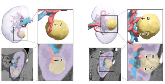 Figure 3 for An Entire Renal Anatomy Extraction Network for Advanced CAD During Partial Nephrectomy