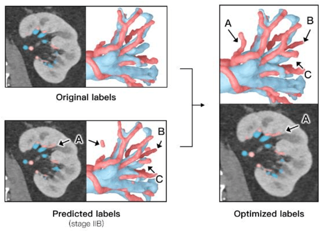 Figure 4 for An Entire Renal Anatomy Extraction Network for Advanced CAD During Partial Nephrectomy