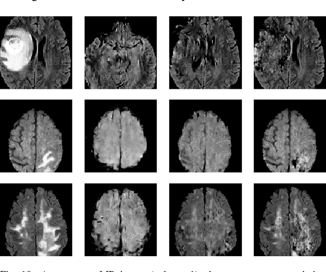 Figure 3 for A novel GAN-based paradigm for weakly supervised brain tumor segmentation of MR images