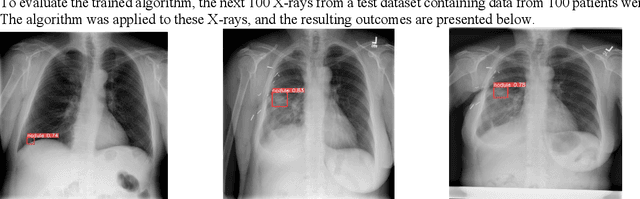 Figure 3 for Leveraging object detection for the identification of lung cancer