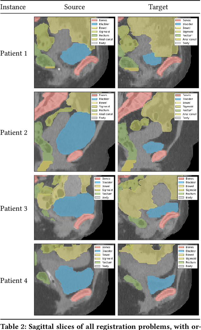 Figure 4 for MOREA: a GPU-accelerated Evolutionary Algorithm for Multi-Objective Deformable Registration of 3D Medical Images