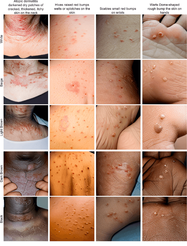 Figure 3 for Using Large Text-to-Image Models with Structured Prompts for Skin Disease Identification: A Case Study