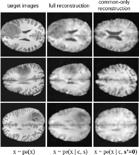 Figure 1 for SepVAE: a contrastive VAE to separate pathological patterns from healthy ones