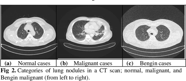 Figure 3 for Evaluating LeNet Algorithms in Classification Lung Cancer from Iraq-Oncology Teaching Hospital/National Center for Cancer Diseases