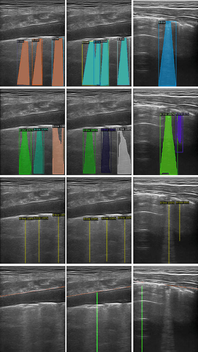 Figure 4 for A Semi-supervised Learning Approach for B-line Detection in Lung Ultrasound Images
