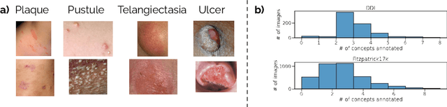 Figure 2 for SkinCon: A skin disease dataset densely annotated by domain experts for fine-grained model debugging and analysis