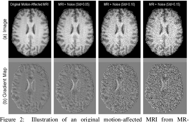 Figure 3 for Iterative Learning for Joint Image Denoising and Motion Artifact Correction of 3D Brain MRI