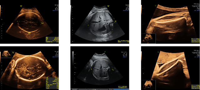 Figure 1 for Removing confounding information from fetal ultrasound images