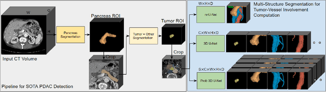Figure 3 for Segmentation-based Assessment of Tumor-Vessel Involvement for Surgical Resectability Prediction of Pancreatic Ductal Adenocarcinoma