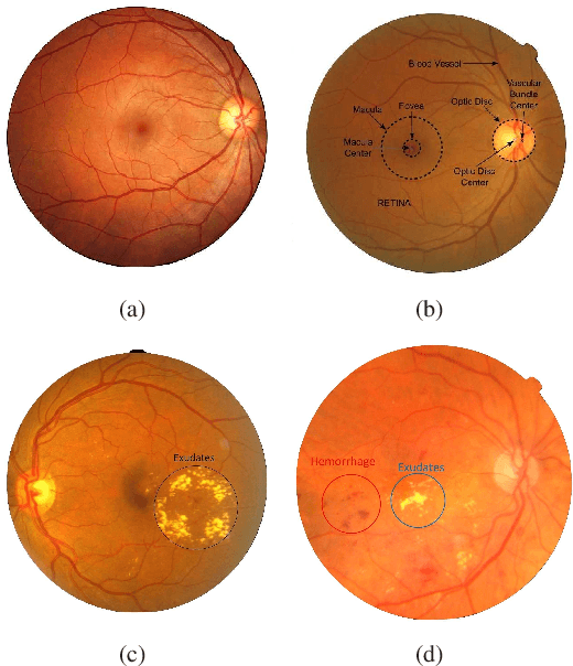 Figure 1 for A Residual Encoder-Decoder Network for Segmentation of Retinal Image-Based Exudates in Diabetic Retinopathy Screening