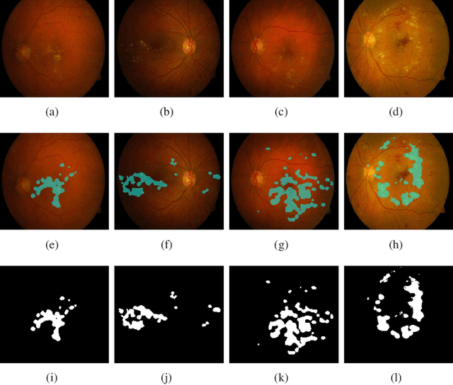 Figure 4 for A Residual Encoder-Decoder Network for Segmentation of Retinal Image-Based Exudates in Diabetic Retinopathy Screening