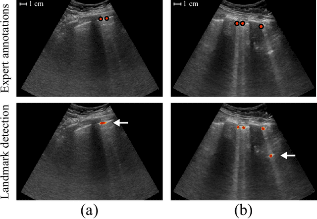 Figure 4 for Deep Learning for Detection and Localization of B-Lines in Lung Ultrasound