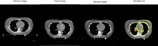 Figure 3 for INR-LDDMM: Fluid-based Medical Image Registration Integrating Implicit Neural Representation and Large Deformation Diffeomorphic Metric Mapping