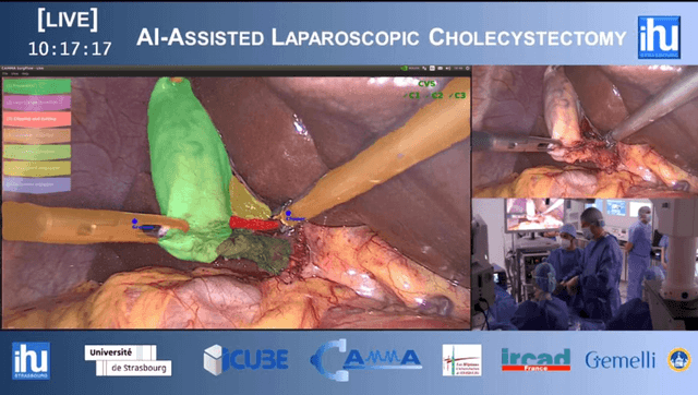 Figure 1 for Real-Time Artificial Intelligence Assistance for Safe Laparoscopic Cholecystectomy: Early-Stage Clinical Evaluation