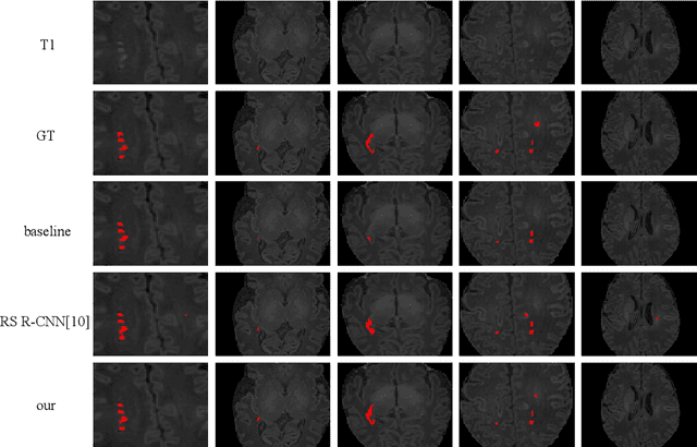 Figure 3 for Punctate White Matter Lesion Segmentation in Preterm Infants Powered by Counterfactually Generative Learning