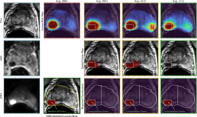 Figure 3 for Mixed Supervision of Histopathology Improves Prostate Cancer Classification from MRI