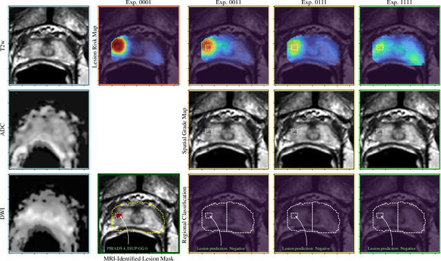 Figure 4 for Mixed Supervision of Histopathology Improves Prostate Cancer Classification from MRI