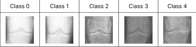Figure 1 for Enhancing Knee Osteoarthritis severity level classification using diffusion augmented images
