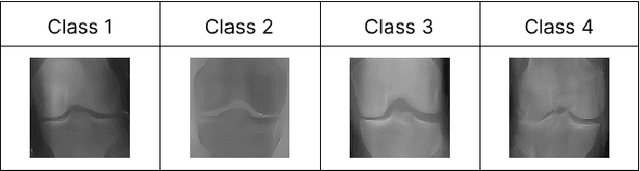 Figure 3 for Enhancing Knee Osteoarthritis severity level classification using diffusion augmented images