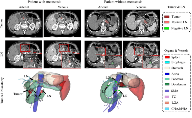 Figure 1 for A deep local attention network for pre-operative lymph node metastasis prediction in pancreatic cancer via multiphase CT imaging