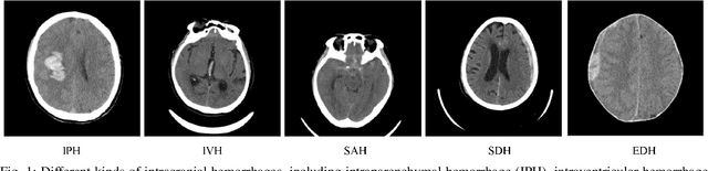 Figure 1 for The state-of-the-art 3D anisotropic intracranial hemorrhage segmentation on non-contrast head CT: The INSTANCE challenge