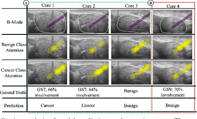 Figure 3 for TRUSformer: Improving Prostate Cancer Detection from Micro-Ultrasound Using Attention and Self-Supervision