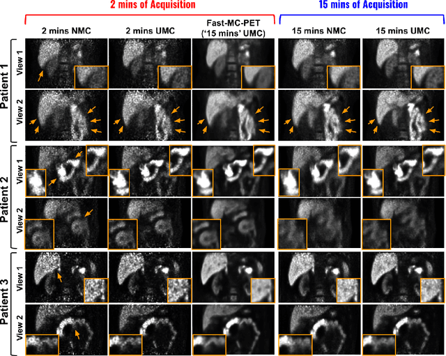 Figure 3 for Fast-MC-PET: A Novel Deep Learning-aided Motion Correction and Reconstruction Framework for Accelerated PET