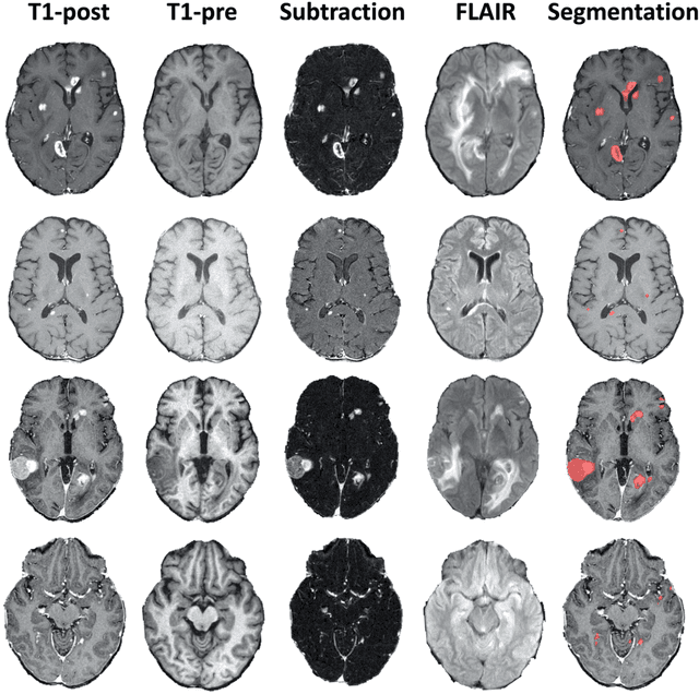 Figure 4 for The University of California San Francisco, Brain Metastases Stereotactic Radiosurgery (UCSF-BMSR) MRI Dataset