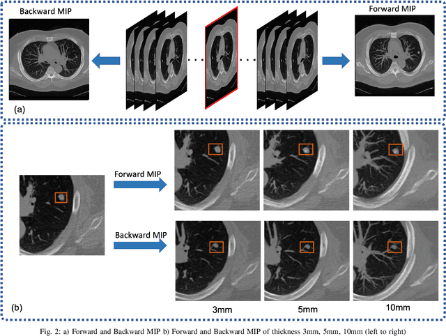 Figure 2 for MEDS-Net: Self-Distilled Multi-Encoders Network with Bi-Direction Maximum Intensity projections for Lung Nodule Detection