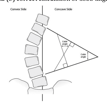 Figure 1 for Automating Cobb Angle Measurement for Adolescent Idiopathic Scoliosis using Instance Segmentation