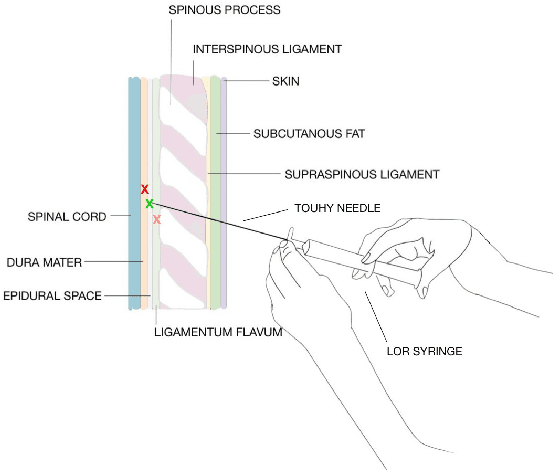 Figure 1 for Design and Validation of a Bimanual Haptic Epidural Needle Insertion Simulator