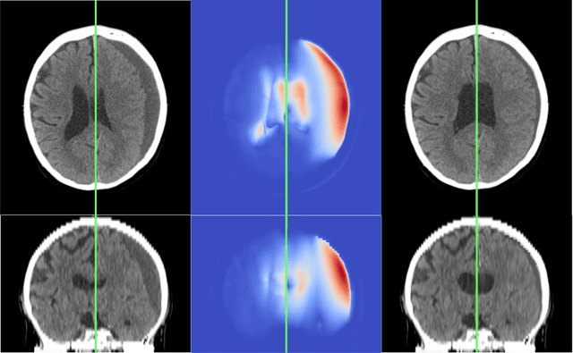 Figure 4 for Brain-Shift: Unsupervised Pseudo-Healthy Brain Synthesis for Novel Biomarker Extraction in Chronic Subdural Hematoma