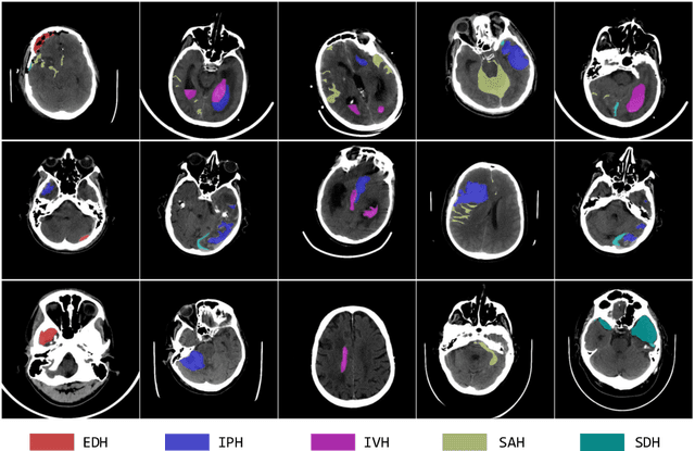 Figure 3 for BHSD: A 3D Multi-Class Brain Hemorrhage Segmentation Dataset