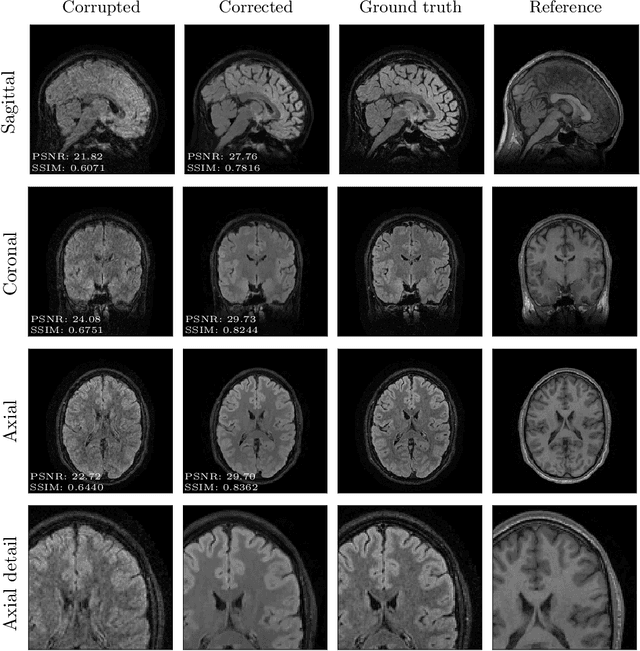 Figure 4 for Towards retrospective motion correction and reconstruction for clinical 3D brain MRI protocols with a reference contrast